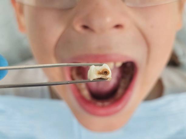Best Emergency Tooth Extraction in Chama, NM